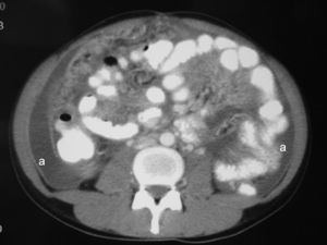 Importante ascitis (a) en ambos canales paracólicos.