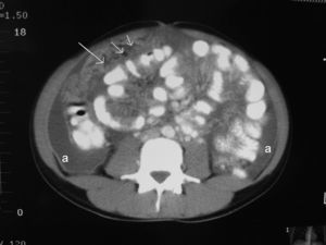 Implantes tumorales en grasa epiploica (flechas).