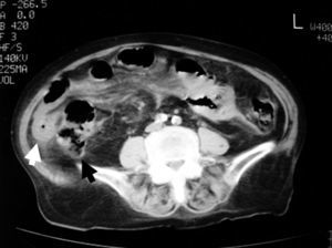 Tomografía computarizada abdominal sin contraste: asa de intestino delgado engrosada (flecha blanca) localizada en la gotiera derecha con desplazamiento anterior y medial del ciego (flecha negra). Vasos mesentéricos elongados.
