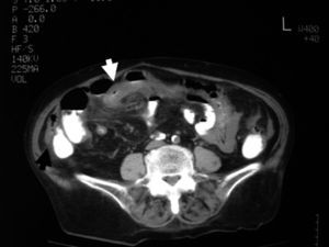Tras la administración de contraste, se muestra el asa desplazada hacia mesogastrio (flecha blanca), con cambio de orientación de los vasos mesentéricos. Ciego en la gotiera derecha (flecha negra).