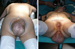 Inspección de la masa sacra. A la derecha, dibujo del colgajo miocutáneo.