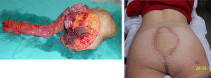 A la izquierda, la pieza extirpada: rectosima, glutectomía mayor parcial y sacrectomía (cuarta y quinta vértebra sacra, y cóccix); a la derecha, el resultado final tras la cicatrización del colgajo miocutáneo del recto anterior del abdomen.
