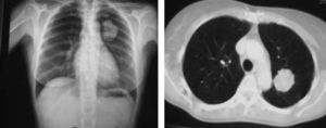 Radiografía de tórax y tomografía computarizada torácica donde puede apreciarse una masa pulmonar en el lóbulo superior izquierdo.