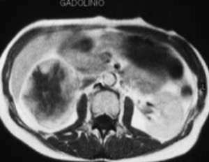 Tomografía computarizada abdominal en la que se observa metástasis suprarrenal derecha.