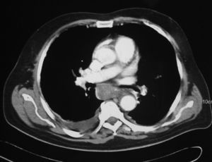 Imagen de la tomografía computarizada compatible con hematoma intramural esofágico.
