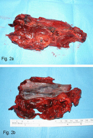 a) Pieza de esofagectomía con hematoma intramural. b) Apertura longitudinal del esófago extirpado.