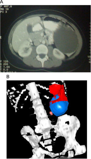 Quiste esplénico localizado en el polo inferior. A) Imagen de la tomografía computarizada. B) Reconstrucción en 3D.