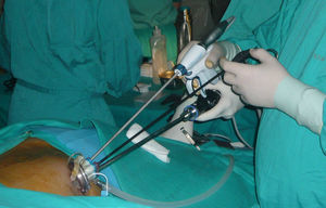 Imagen intraoperatoria del procedimiento.