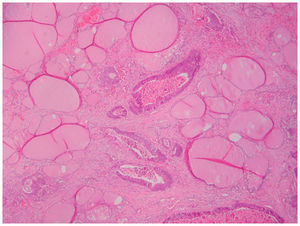 Glándula tiroidea infiltrada por adenocarcinoma de alto grado de patrón enteroide.