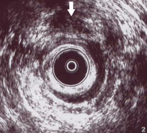 Imagen de ecografía endoanal de una paciente con incontinencia fecal donde se observa un gran defecto anterior en el esfínter anal externo e interno.
