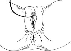 Esquema que muestra incisión cutánea perianal (línea discontinua) que se realiza en la reparación anterior del esfínter anal en la mujer.