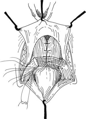Esquema que muestra la sutura mediante la técnica de superposición tras la liberación de ambos extremos del esfínter anal externo en la reparación anterior del esfínter anal.