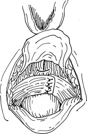 Esquema que muestra la visión final de la sutura mediante la técnica de superposición de ambos extremos del esfínter anal externo en la reparación anterior del esfínter anal.