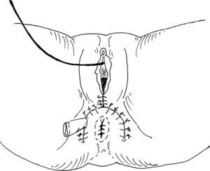 Esquema que muestra la sutura de la piel tras la realización de una reparación anterior del esfínter anal.
