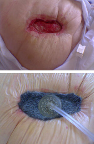 Colocación del poliuretano en la superficie de la herida.