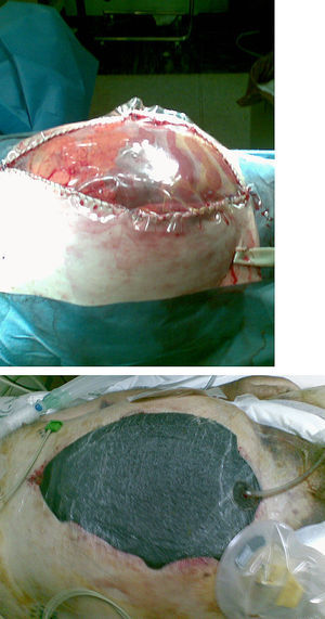 Colocación de la terapia VAC en un caso clínico de abdomen abierto.