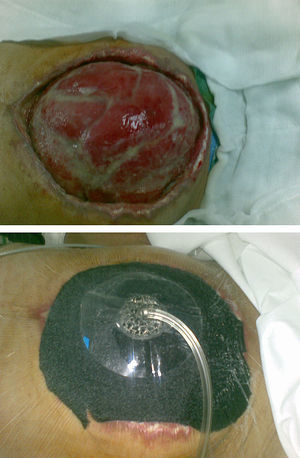 Sistema VAC «intraabdominal».