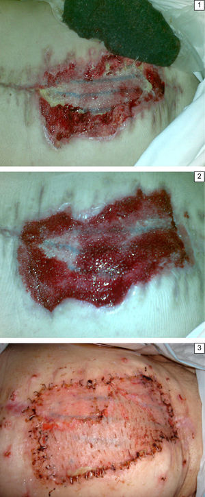 Sistema VAC suprafascial aplicado sobre malla1. Tejido de granulación tras terapia VAC2. Injerto sobre tejido de granulación3.