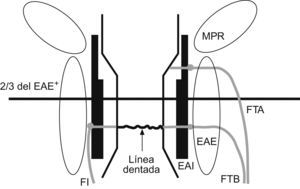 Esquema del canal anal. EAI: esfínter anal interno; EAE: esfínter anal externo; FI: fístula interesfintérica; FTA: fístula transesfintérica alta; FTB: fístula transesfintérica baja; MPR: músculo puborrectal. +Línea divisoria entre el canal anal alto y bajo.