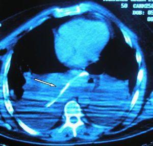 Sonda nasogástrica en el estómago ascendido al tórax.