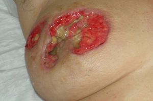 Úlcera cutánea en la mama derecha de tórpida evolución.