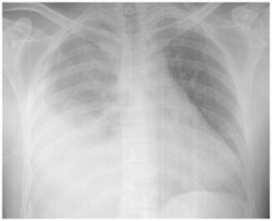Radiografia del tórax a las 48h del traumatismo.