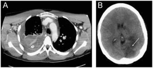 Tomografía axial computarizada (TAC) que evidencia abundante derrame pleural con coágulos a pesar de drenaje torácico. La TAC demuestra lesión isquémica en el área correspondiente de la arteria cerebral posterior.