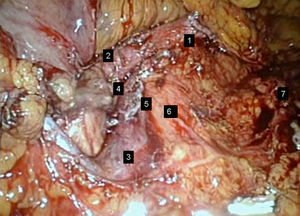 Lecho quirúrgico: estructuras anatómicas disecadas. 1) Arteria esplénica seccionada en su origen. 2) Arteria hepática común. 3) Vena mesentérica superior. 4) Vena porta. 5) Borde de sección de la vena esplénica en su desembocadura en la porta. 6) Arteria mesentérica superior. 7) Glándula suprarrenal izquierda.