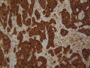 Carcinoma de célula pequeña con tinción inmunohistoquímica positiva para cromogranina A (cromogranina A×100).
