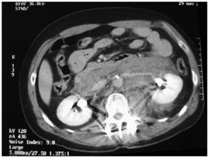 TC con gran hematoma retroperitoneal y proyectil.