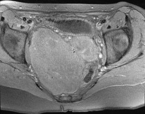 Gran lesión hipodensa en la pelvis de unos 30×25cm que comprime y desplaza lateralmente el útero, la vejiga y el recto.