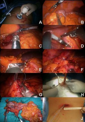 A) Dispositivo single port. B) Hilos y tracción de meso para disección. C) Disección parietocólica derecha con Ligasure Atlas®. D) Sección del íleon terminal. E) Sección del colon transverso. F) Anastomosis ileocólica. G) Cierre del orificio residual tras anastomosis mecánica. H) Extracción de la pieza quirúrgica. I) Pieza quirúrgica. J) Cicatriz postoperatoria (2,5cm).