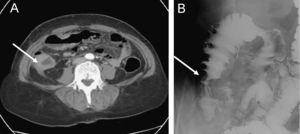 A) TC: engrosamiento circunferencial de la pared del colon ascendente. B) Enema opaco: lesión intramural a la altura del colon ascendente con marcada reacción desmoplástica.