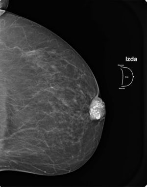 Imagen nodular retroareolar con densa calcificación en su interior, BI-RADS IV.