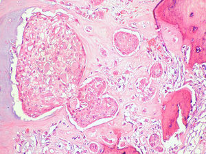 Nidos de células tumorales en el seno de una estroma con algunas áreas mixoides. A la derecha, focos de metaplasia ósea (H-E, ×400).