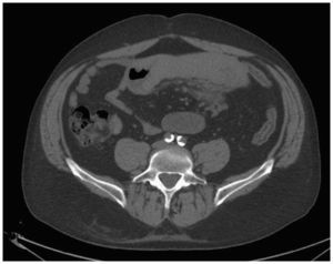 Tomografía computarizada del abdomen. Distensión del intestino delgado con engrosamiento del yeyuno.
