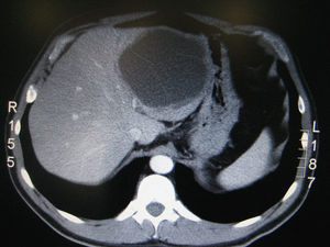 TC abdominal con contraste i.v. que muestra una lesión quística con tabiques internos ubicada en el lóbulo hepático izquierdo.