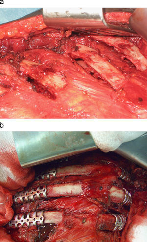 a) Reducción abierta de las fracturas costales. b) Fijación interna costal con grapas costales de titanio.