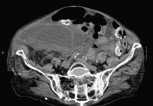 TAC abdominal.