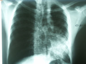 Imágenes quísticas en la base pulmonar izquierda, con pérdida de volumen y expansión del pulmón derecho.