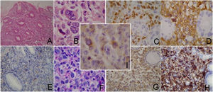 Histopatología e inmunopatología. A) Hematoxilina-eosina (4×), B) Hematoxilina-eosina (40×), C) K67, D) CD30, E) CD20, F) CD45-Ro, G) CD4, H) CD8, I) ALK.