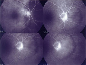 Angiofluorografía ocular.