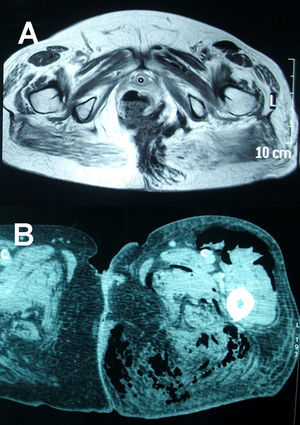 A) RNM T1 pelvis. Gran defecto de cara posterior de anastomosis colorrectal en continuidad con colección isquiorrectal izquierda. B) RNM T1 raíz de muslo con absceso a dicho nivel.