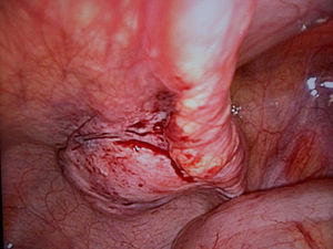Imagen intraoperatoria laparoscópica del quiste de uraco, que aparece como una protrusión a la derecha del uraco.