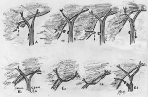 Clasificación Strasberg LIVB. A) Fuga del muñón del c.cístico o fuga de un canalículo en el lecho hepático. B) Oclusión de una parte del árbol biliar, casi invariablemente un conducto hepático derecho aberrante. C) Transección sin ligadura del conducto hepático derecho aberrante. D) Daño lateral a un conducto hepático mayor. E) Subdivida por la clasificación de Bismuth en E1–E5.