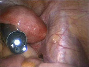 Abordaje transvaginal con el endoscopio flexible. El acceso con trócar quirúrgico asegura el canal de entrada y evita la contaminación del endoscopio.