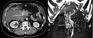 Imagen de TAC y reconstrucción vascular, donde se aprecia el hematoma y el psudoaneurisma pancreatoduodenal señalado con flecha.