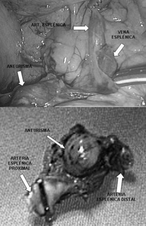 Imagen intraoperatoria y pieza de resección del aneurisma de la AE.