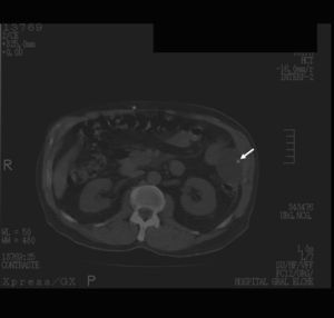 TC abdominal. Quiste intraabdominal en el flanco izquierdo inferior al bazo y a la altura de las venas renales con la punta del catéter en su interior.