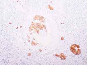 Imagen con tinción inmunohistoquímica que muestra hiperplasia irregular de islotes de Langerhans con distribución atípica (tinción con sinaptofisina;×10).